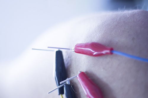 Electroacupuncture Treatment Appears to Reduce Fibromyalgia Pain, Review Shows