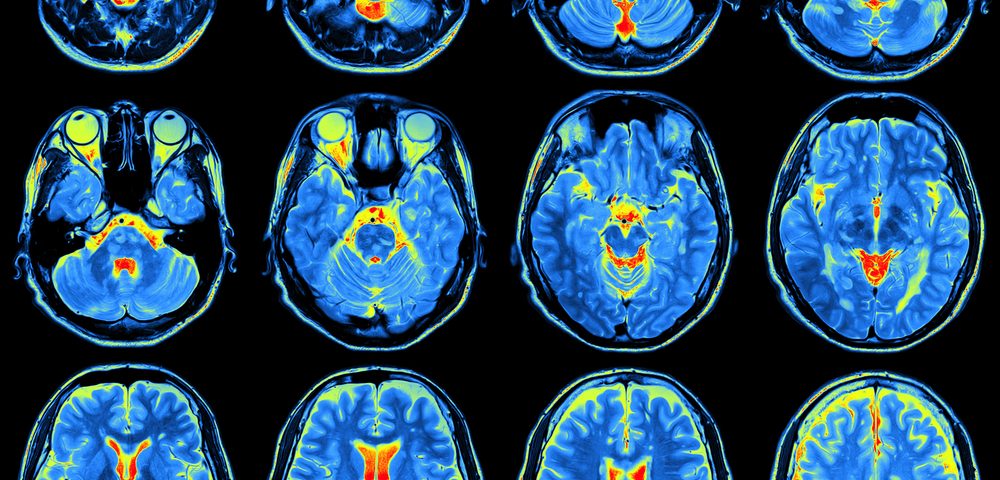 Brain Changes May Explain Chronic Pain Symptoms in Different Disorders