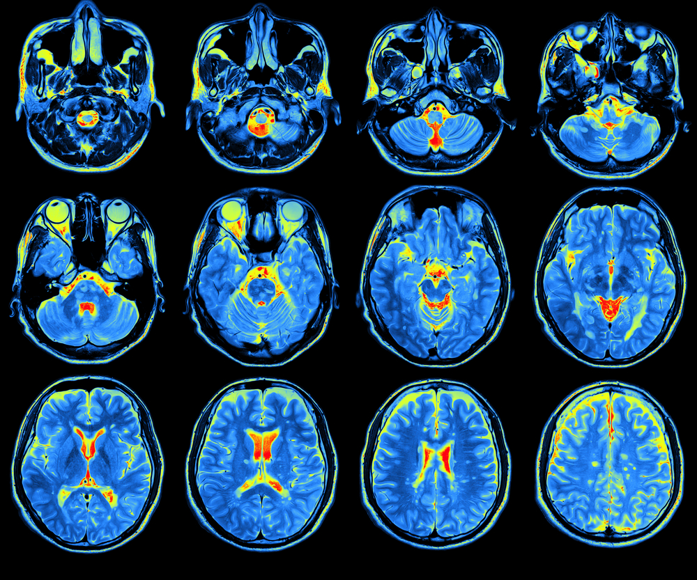 Brain Changes May Explain Chronic Pain Symptoms in ...